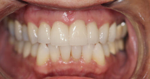 Teeth-1-After